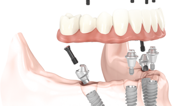 All-on-4 Perth (Full Arch & Full Mouth Dental Implants)