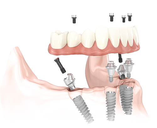 All-on-4 Perth (Full Arch & Full Mouth Dental Implants)
