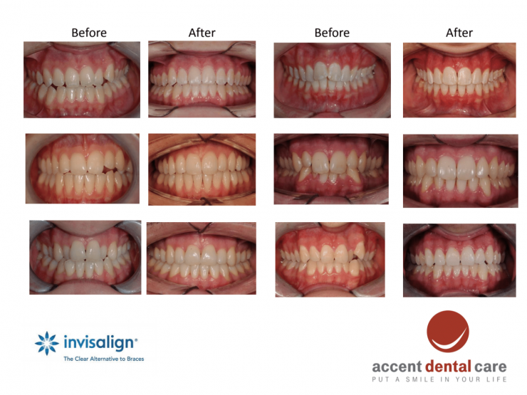 Invisalign Perth WA, Clear & Invisible Braces Accent Dental